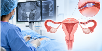 Tubal Recanalization: A Fertility-Sparing Option for Blocked Tubes